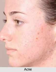 Natural Remedy for Acne, Naturopathy