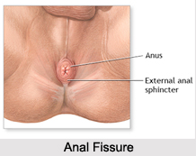 Anal Ailments, Naturopathy