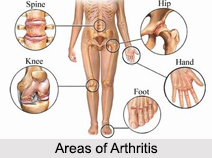 Arthritis, Bone Ailment