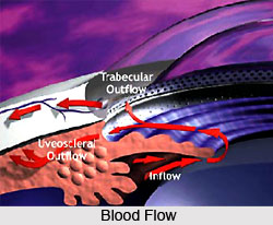 Causes of Glaucoma