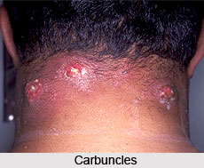 Types of Boils