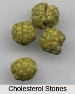 Causes of Gall Bladder Stones