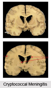 Types of Meningitis