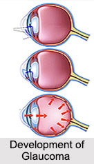Glaucoma, Eye Disorder