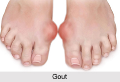 Types of Arthritis, Bone Ailment