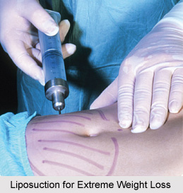Extreme Weight Loss