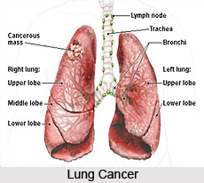 Types of Cancer