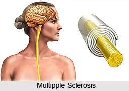 Multiple Sclerosis