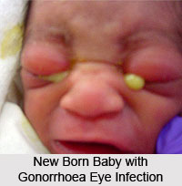 Gonorrhoea or Ushnavata