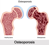Naturopathy for Bone Diseases, Indian Naturopathy