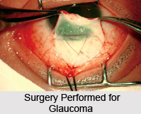 Treatment of Glaucoma