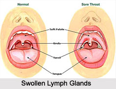 Sore Throat, Naturopathy