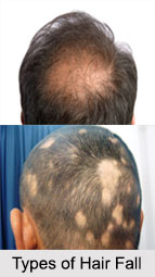 Hair Fall, Hair Disorder