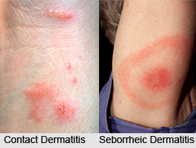 Dermatitis
