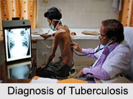 Tuberculosis, Chest Ailment