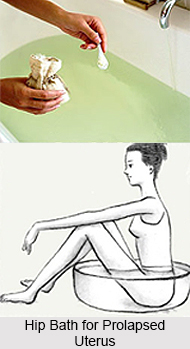 Natural Remedy for the Prolapse of Uterus, Naturopathy