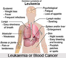 Types of Cancer