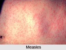 Types of Common Fever
