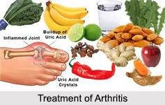 Arthritis, Bone Ailment