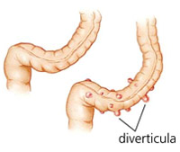 Diverticulosis