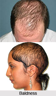 Baldness or Khalitya