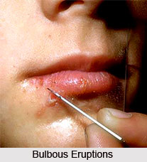 Bulbous Eruptions or Visphotaka Jwara