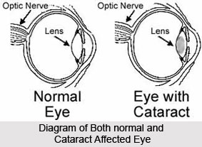 Causes of Cataract