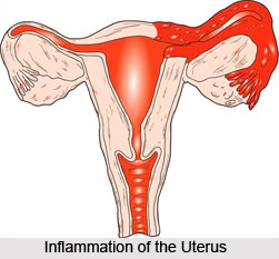 Causes of Inflammation of the Uterus