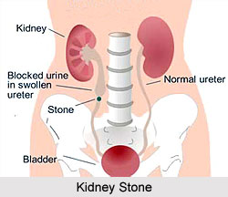 Causes of Kidney Disorders