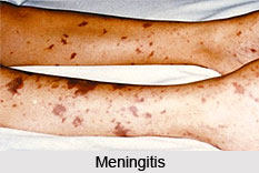 Causes of Meningitis