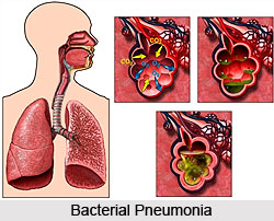 Causes of Pneumonia