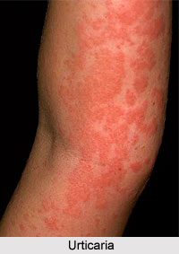 Causes of Urticaria