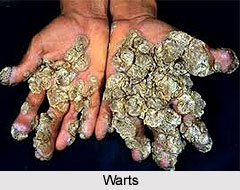 Warts