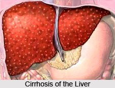 Cirrhosis of the Liver