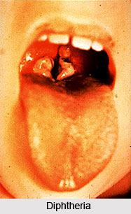Diphtheria or Rohini