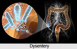 Dysentery