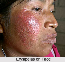 Erysipelas or Visarpa