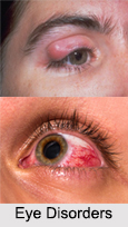 Eye Disorders, Naturopathy