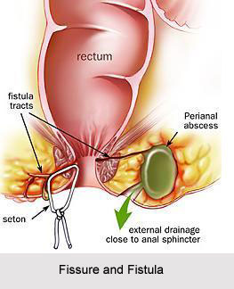 Fissure and Fistula