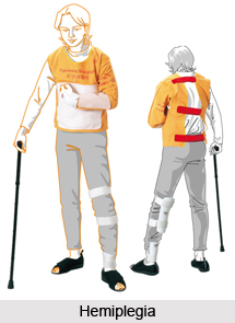 Ayurvedic Massage in Hemiplegia
