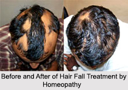 Homeopathic Treatment for Hair Fall