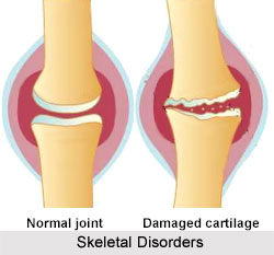 Homoeopathy in Skeletal Disorders
