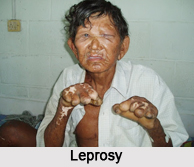 Leprosy, Naturopathy
