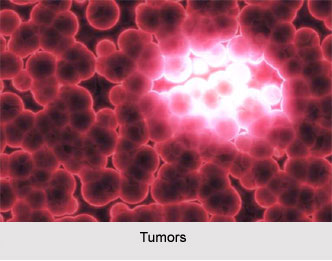 Magnetic Effect on Control and Remission of Tumors