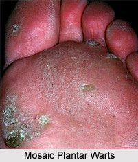Mosaic Plantar Warts