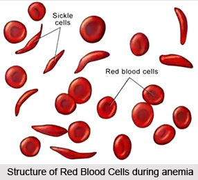Natural Remedy for Anaemia, Indian Naturopathy