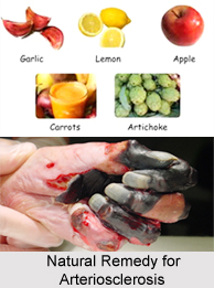 Natural Remedy for Arteriosclerosis, Indian Naturopathy
