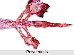 Neuritis