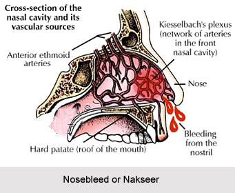 Nosebleed or Nakseer