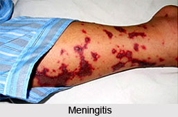 Prevention of Meningitis